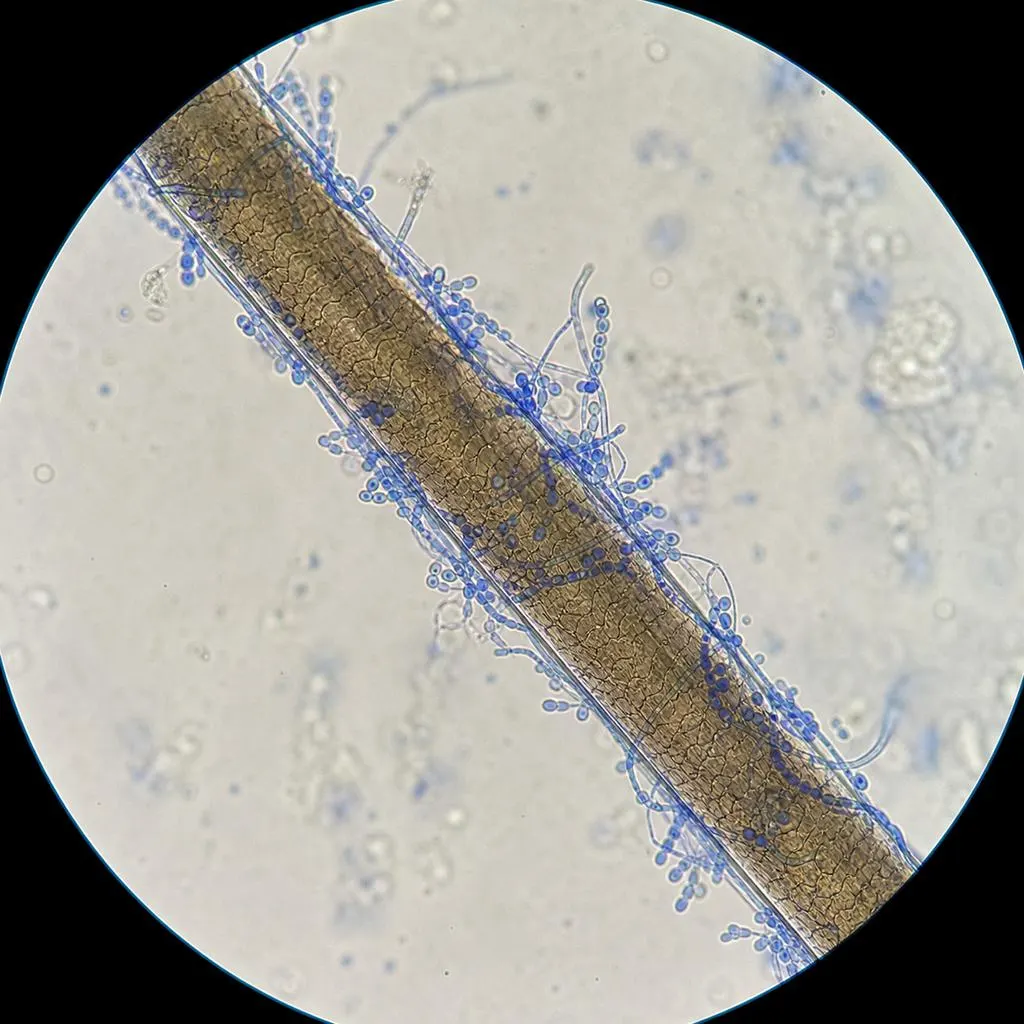 L'examen microscopique permet d'identifier les champignons responsables Examen microscopique montrant des spores fongiques autour d'une tige capillaire