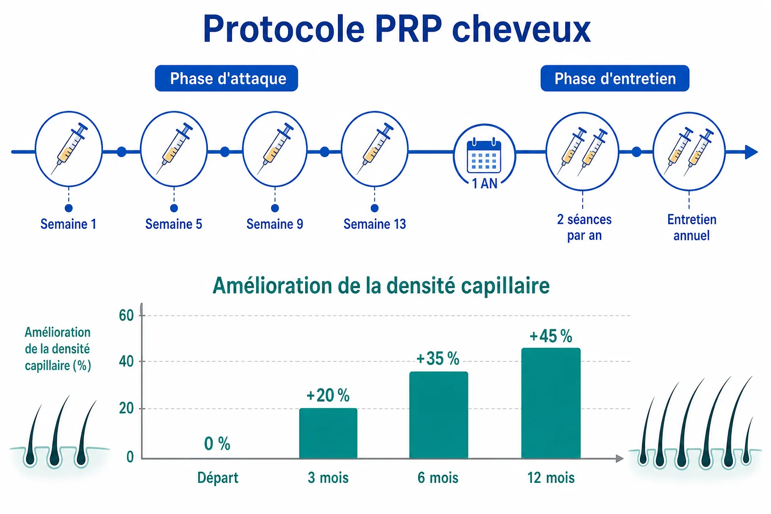 Protocole PRP cheveux : 4 séances d'attaque espacées de 4 semaines puis 2 à 3 séances d'entretien annuelles